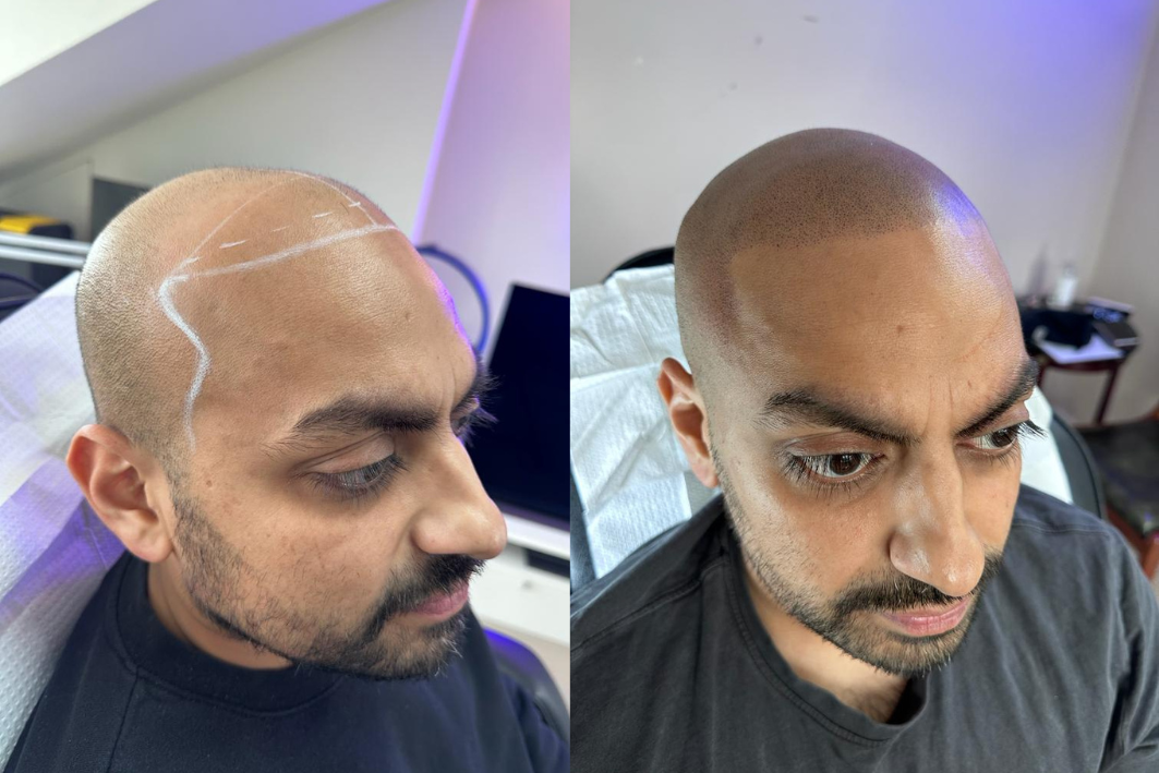 Side-by-side comparison of a man before and after getting a scalp micropigmentation tattoo, showing a fuller look with the treatment.