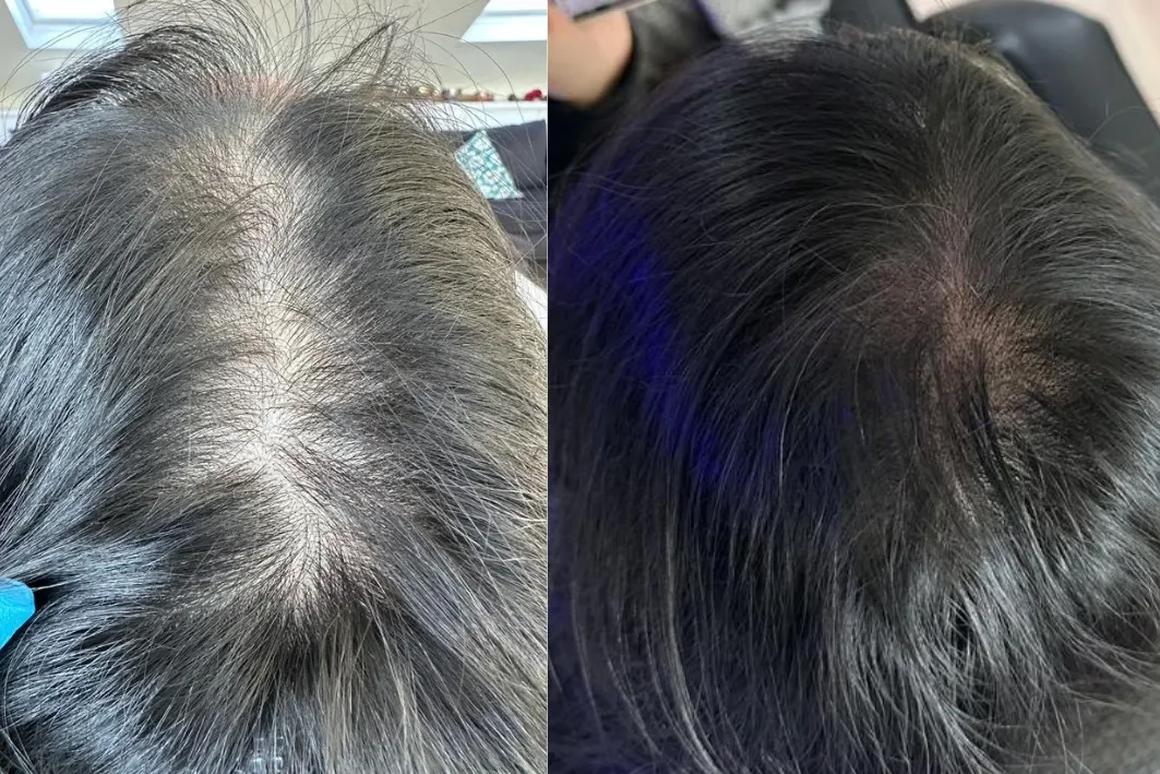 Comparison of a scalp with gray hair before and after hair treatment showing color renewal and improved hair coverage.