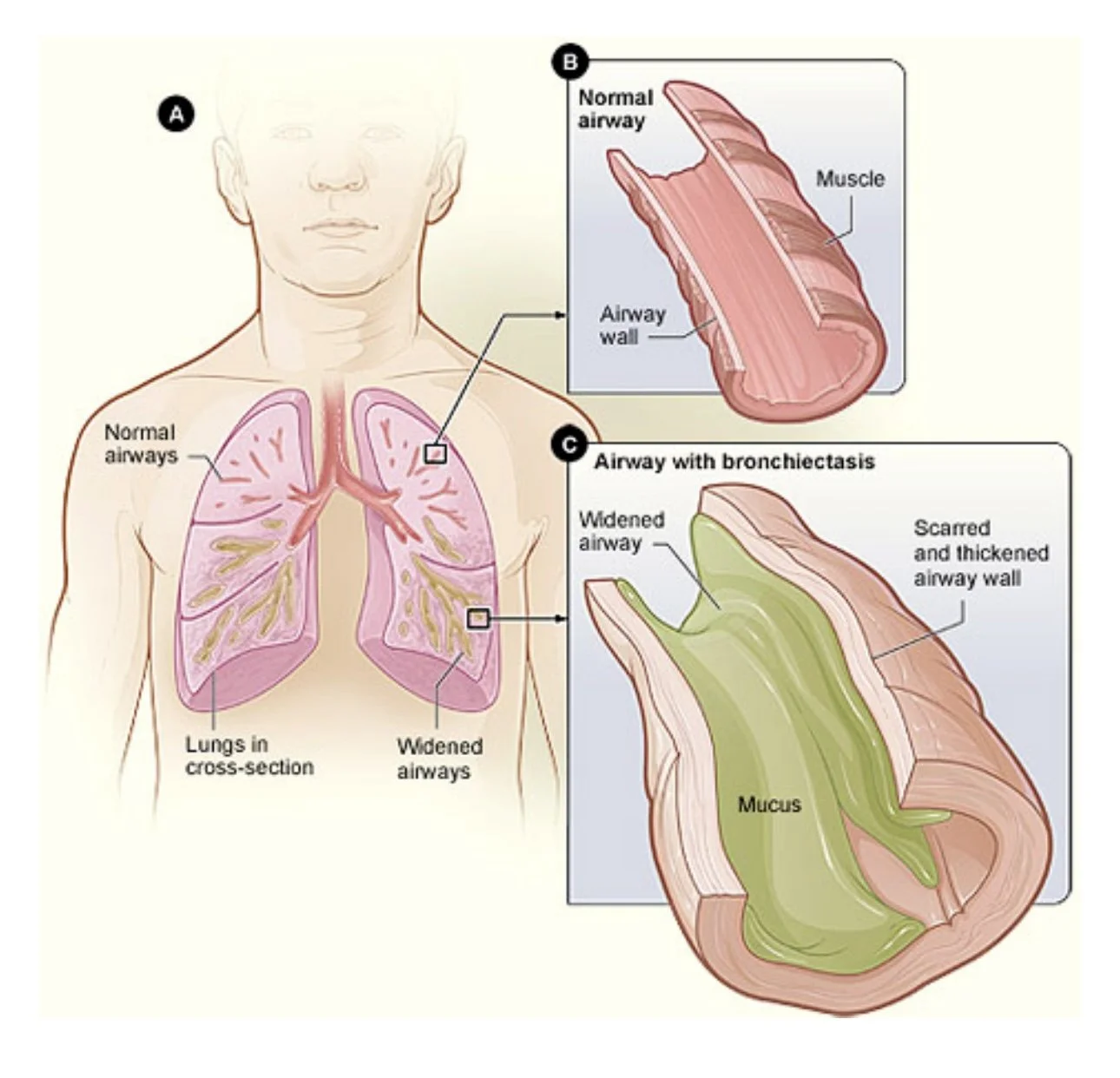 Scarred bronchiectasis airways showing trapped mucus due to impaired clearance