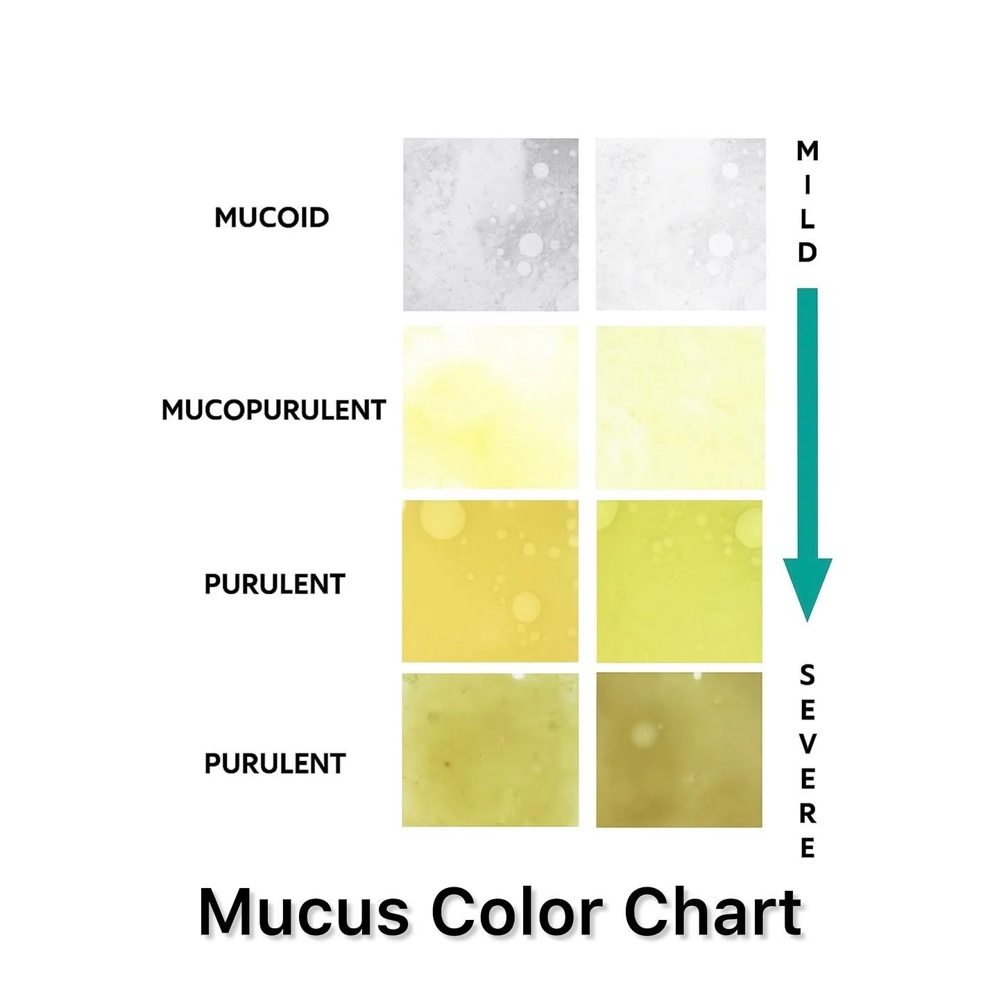Why Sputum Color Matters in Bronchiectasis