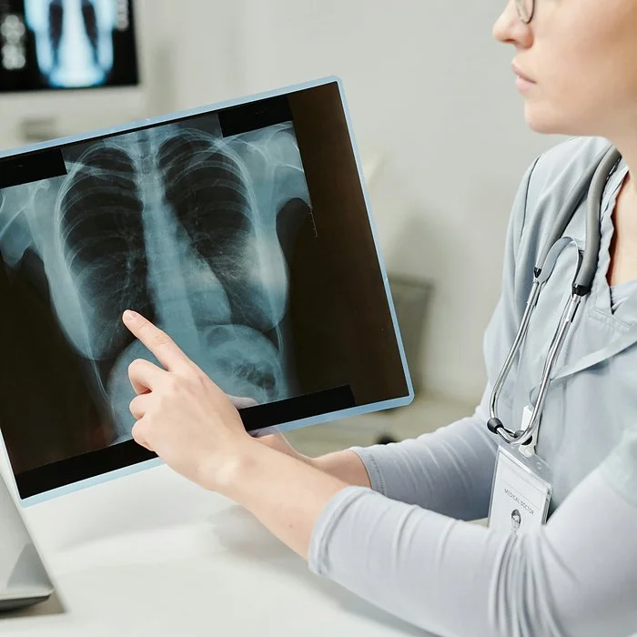 doctor holding chest xray pointing to pneumonia