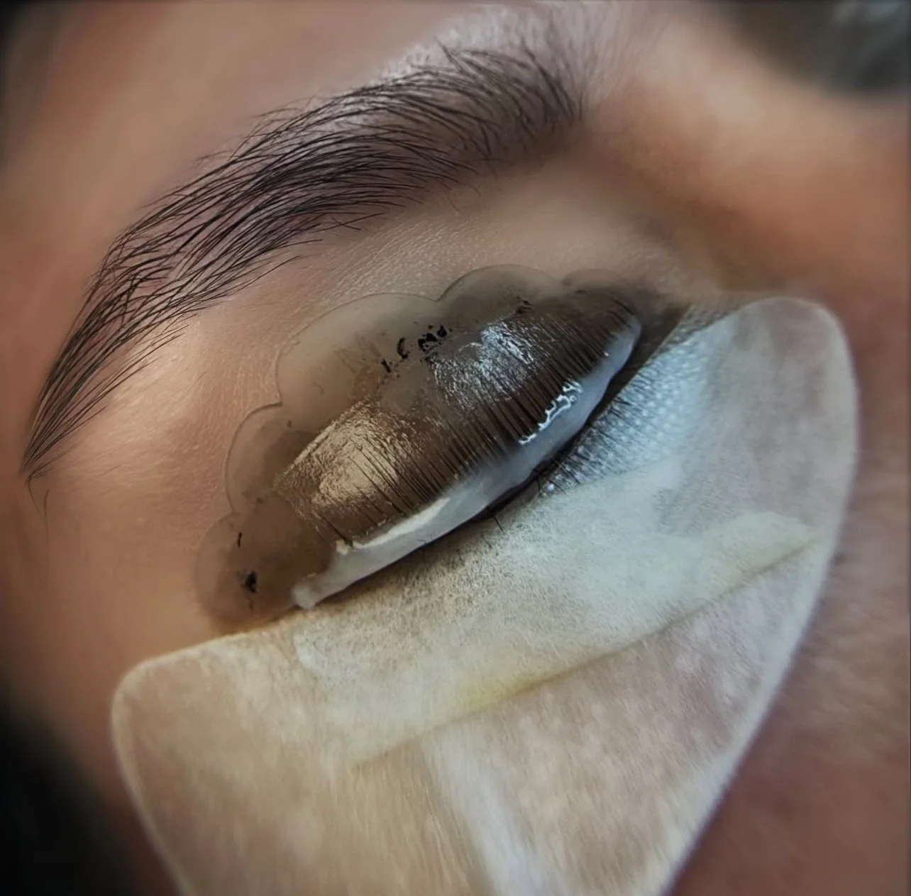 Close-up of a person's eye with an eye patch and a transparent silicone sheet over the eye, possibly for medical purposes.