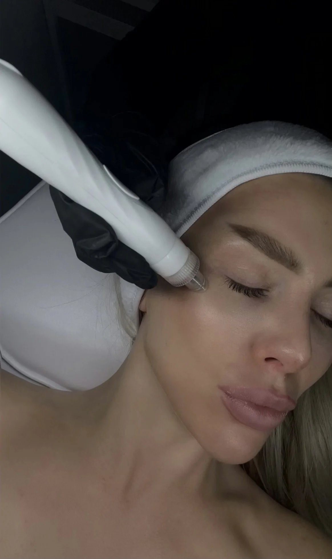 A woman with closed eyes receiving a facial treatment with aDevice on her cheek, lying on a treatment bed with a pillow.