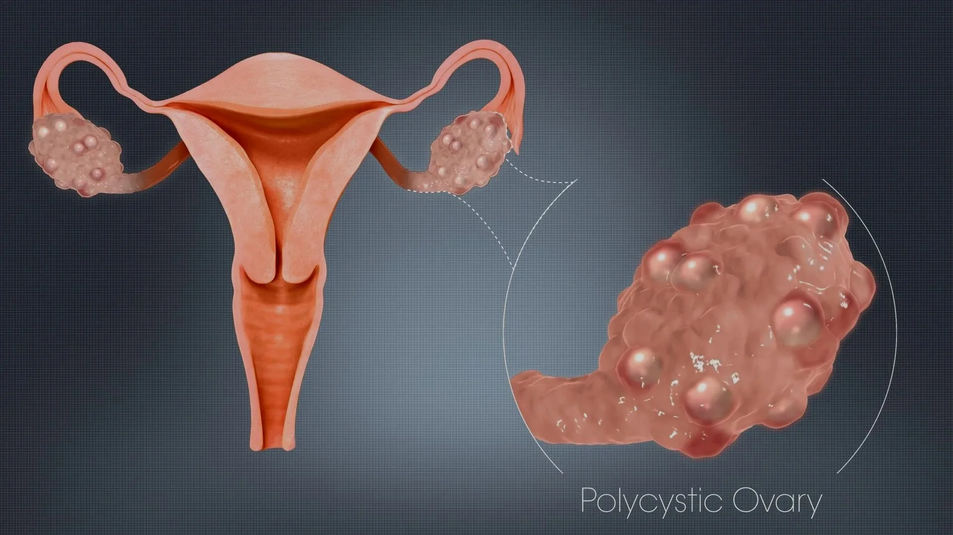 PCOS - Symptoms, Diagnosis and Treatment 