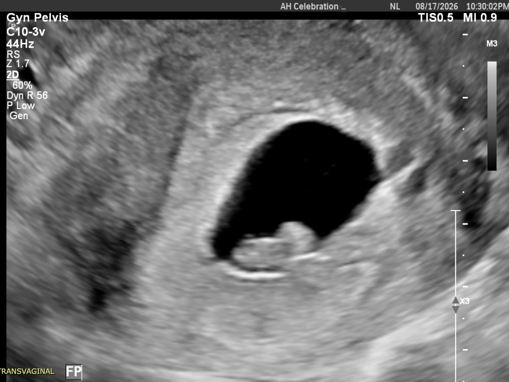 The Truth About Insulin Resistance, Egg Quality, and Miscarriage: My Story &amp; What Science Misses