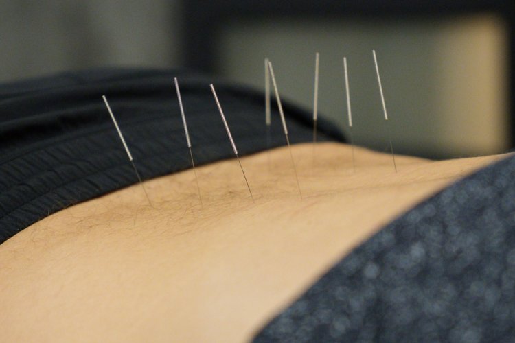 Sports acupuncture treatment at SHIELD Burlington