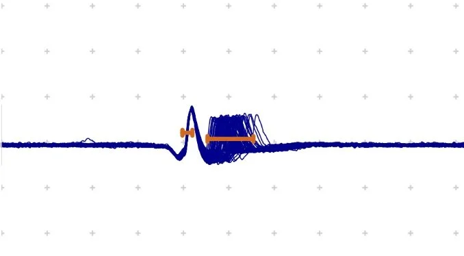 Eletromiografia de Fibra Única (Jitter)
