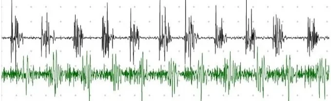 Avaliação eletrofisiológica de tremor