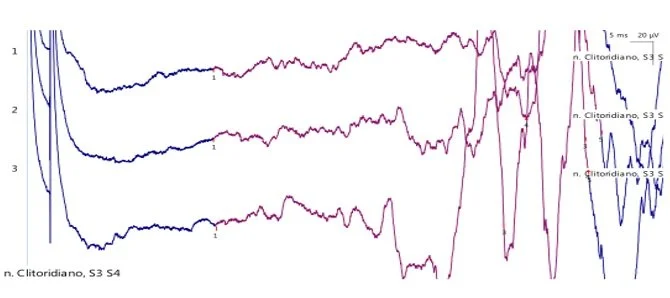 Avaliação do nervo pudendo