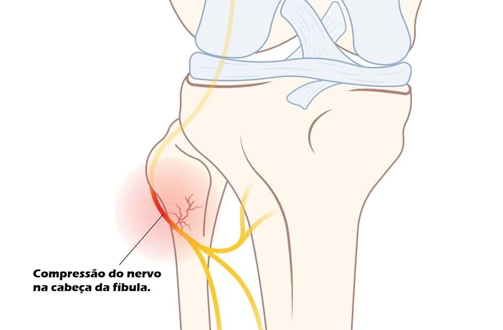 Nervo fibular com compressão na cabeça da fíbula