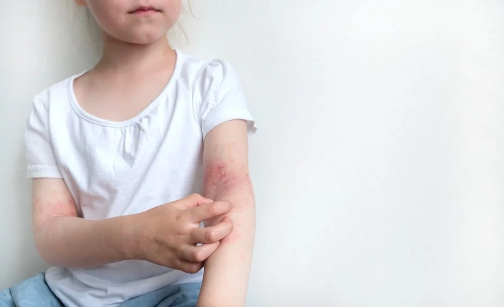 Childhood Eczema — Tips for Parents
