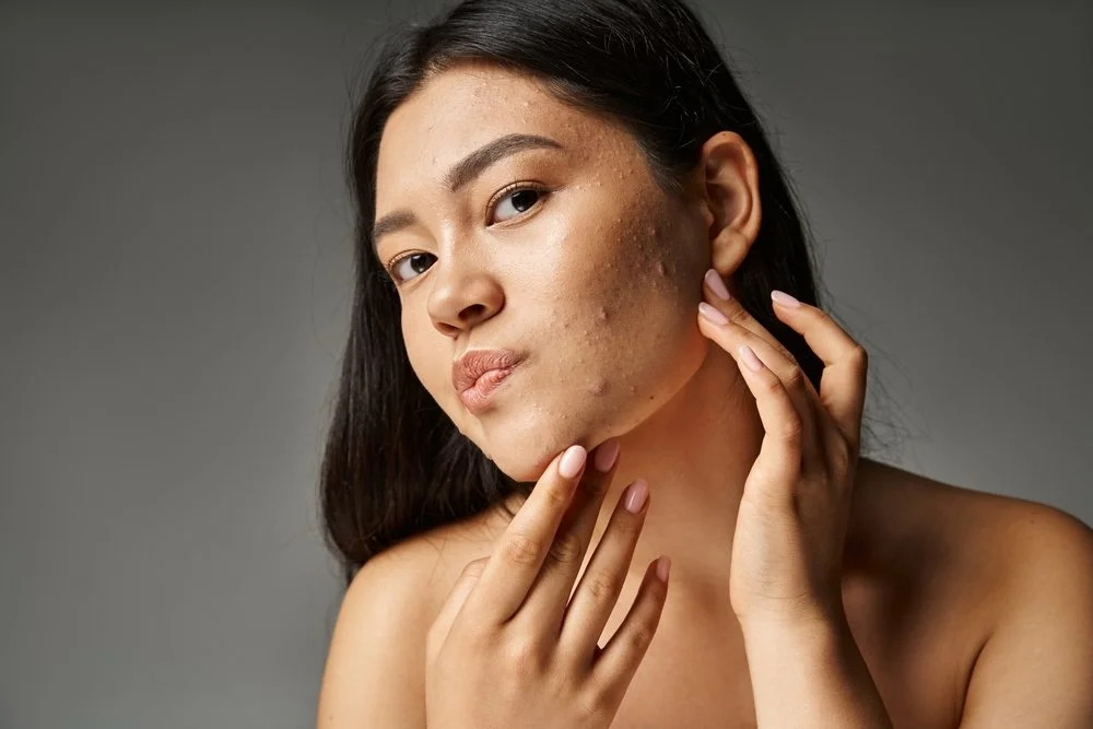 Acne Myths vs. Facts