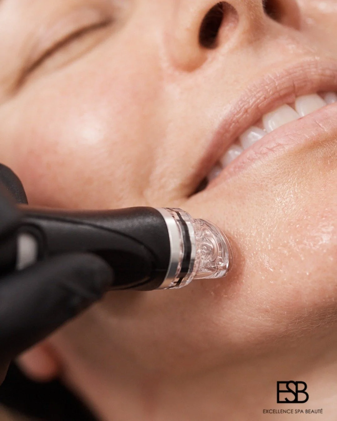 Le HydraFacial est un soin innovant qui combine nettoyage, exfoliation, extraction et hydratation en un seul traitement 

✨ Nettoyage &amp; Exfoliation : &eacute;limine les cellules mortes et pr&eacute;pare la pea 
✨ Extraction douce : d&eacute;sobst