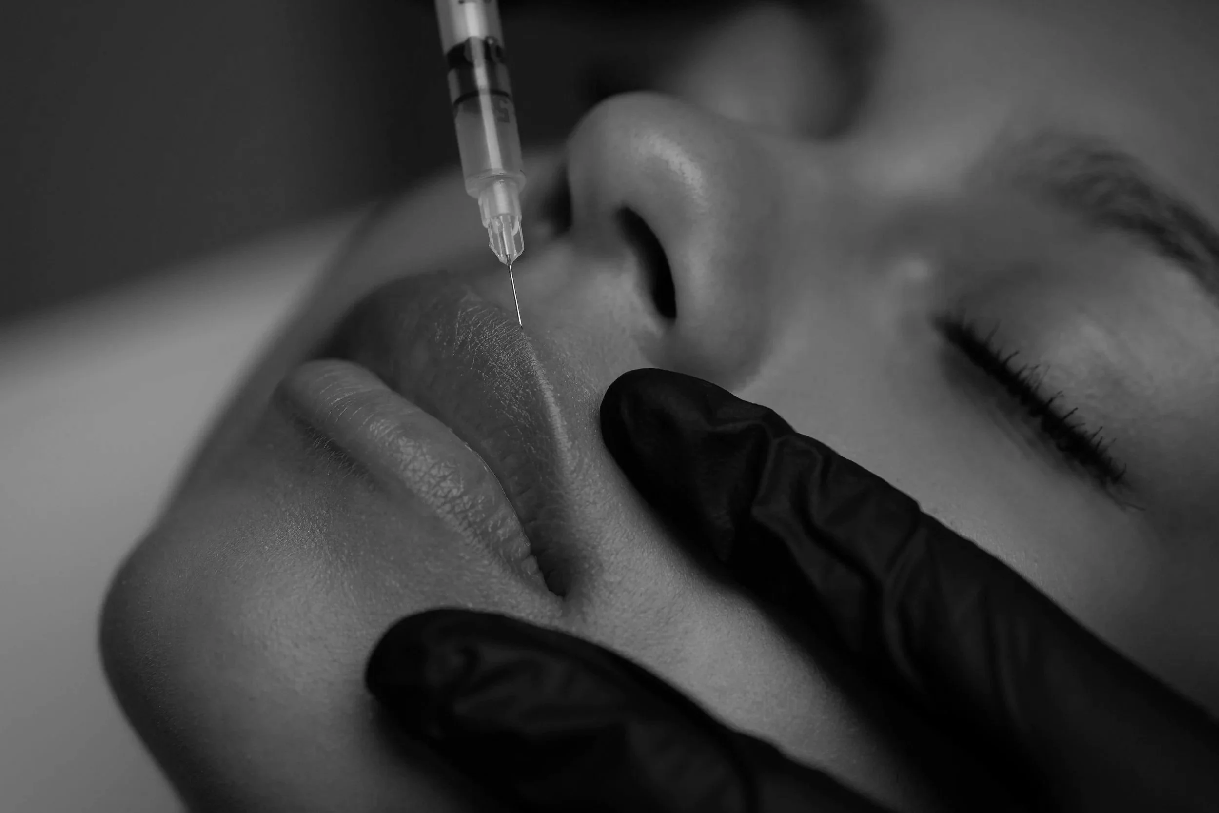 Close-up of a person receiving a lip injection with a syringe, held by a gloved hand, in a monochrome photograph.