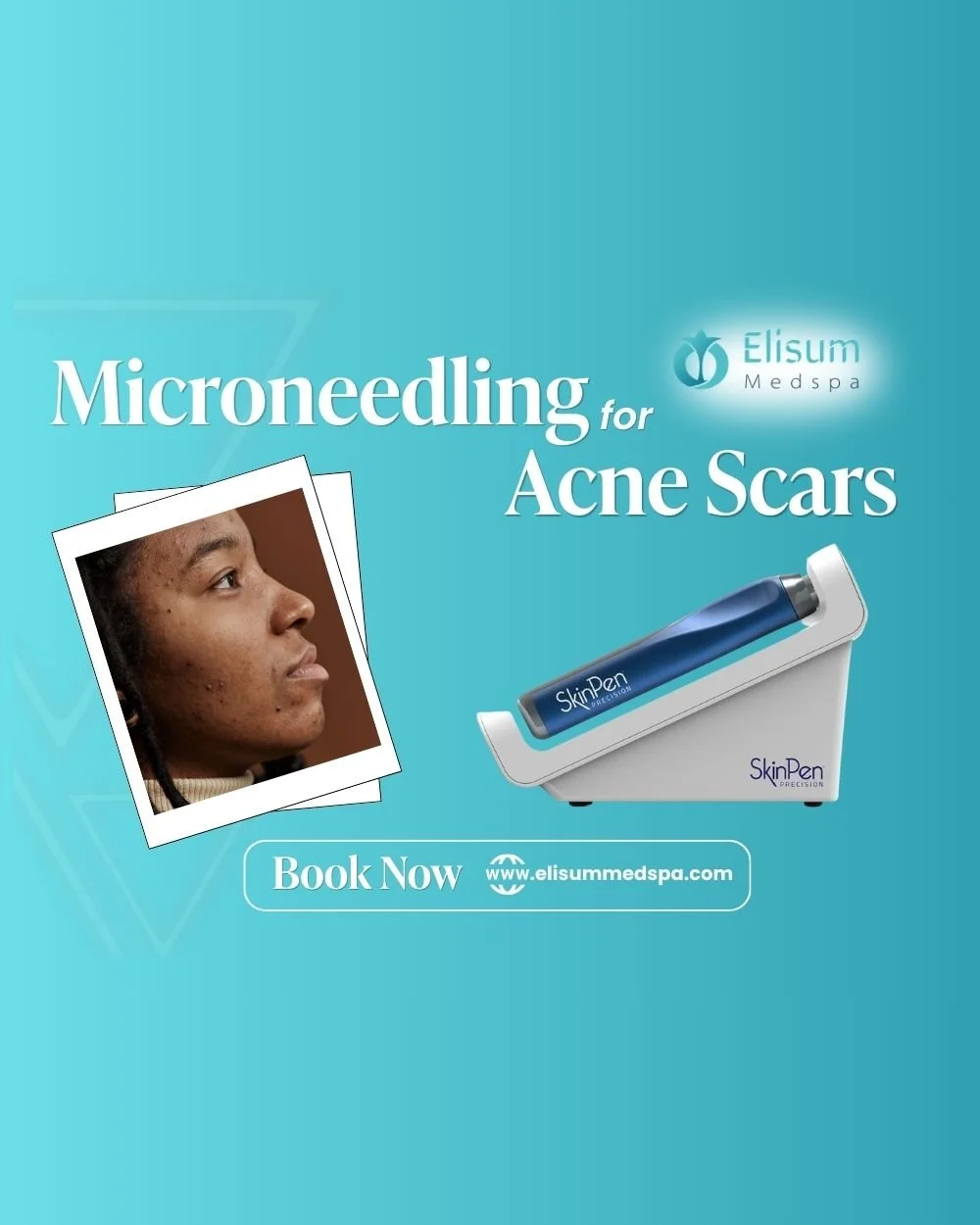 Microneedling for Acne Scars in Frisco, TX | Get Smoother, Clearer Skin