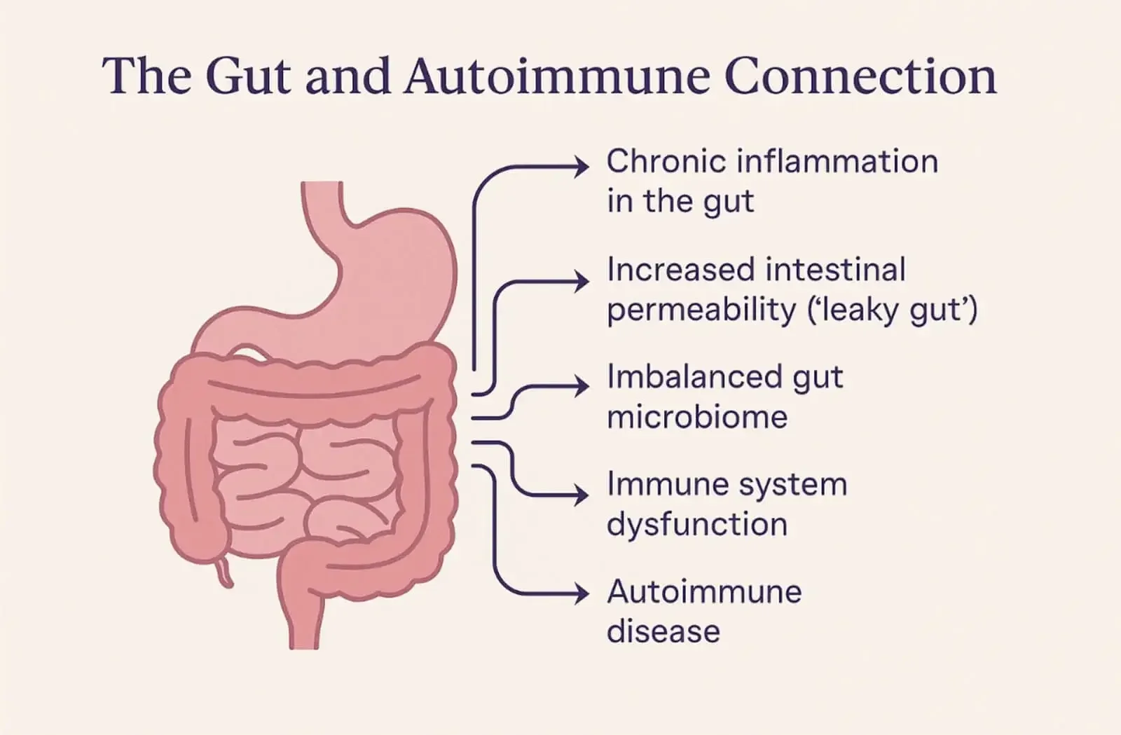 Illustration showing the connection between gut health and autoimmune disease, including chronic gut inflammation, leaky gut, microbiome imbalance, and immune dysfunction — explained by Lantern Clinic Functional Medicine.