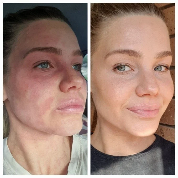 Side-by-side comparison of a woman with visible skin inflammation on the left and clear skin on the right.