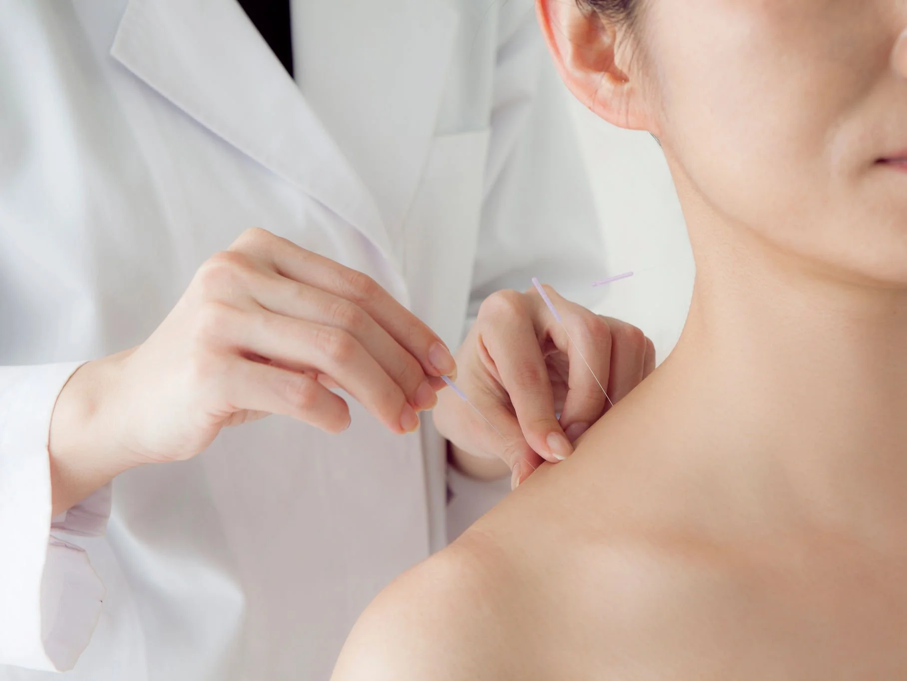 Seattle Times Looks at How to Find an Acupuncturist