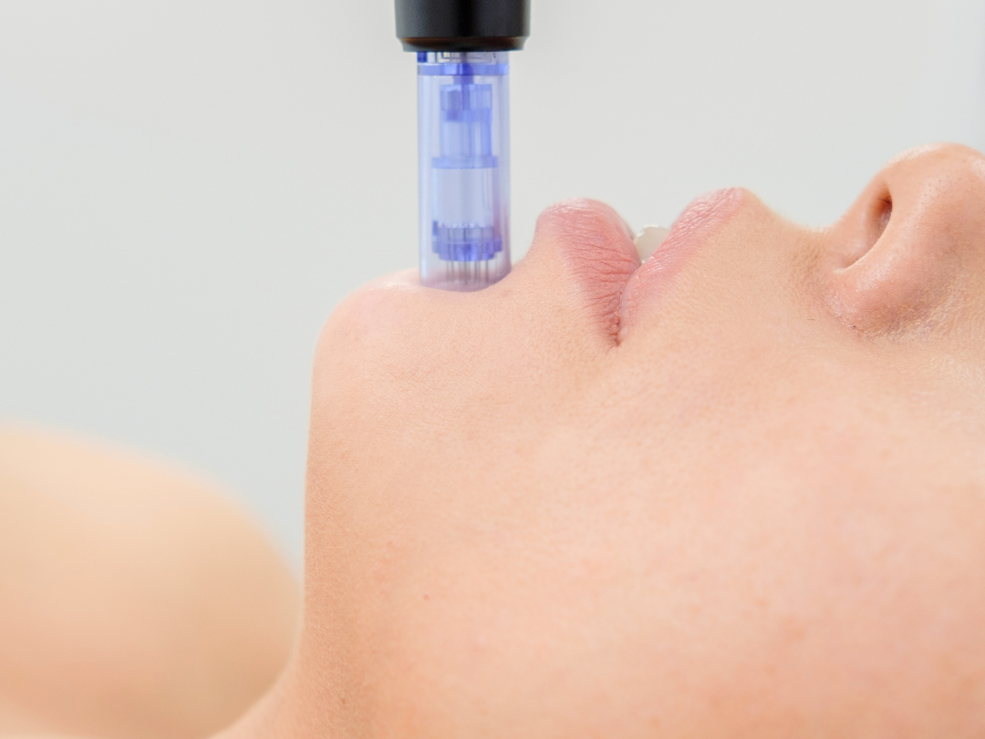 What is Microneedling?