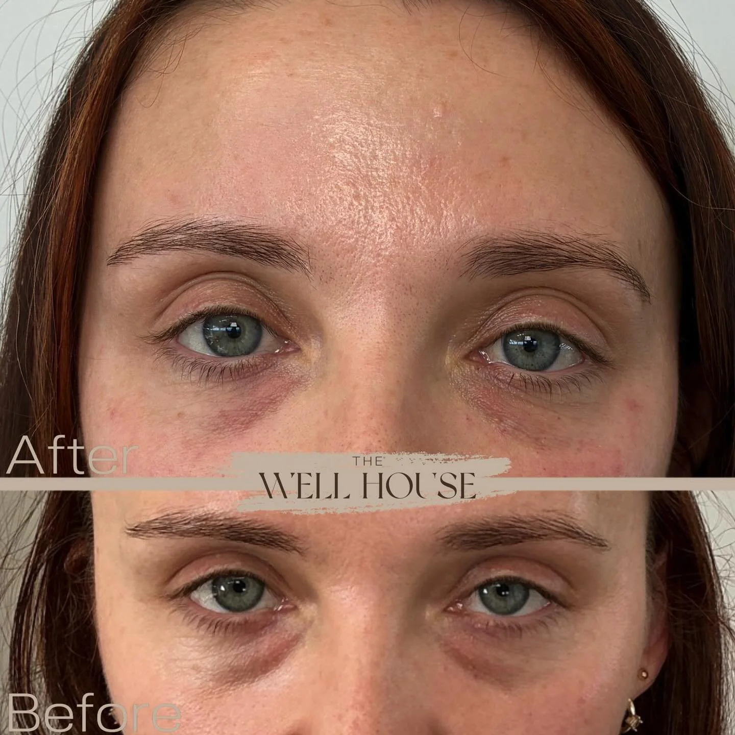 I know what you want ✨👀

Under-eye filler magic! This treatment is all about restoring volume + softening the transition from the tear trough to the cheek. With strategic, conservative placement, filler can help brighten the under-eye area and enhan