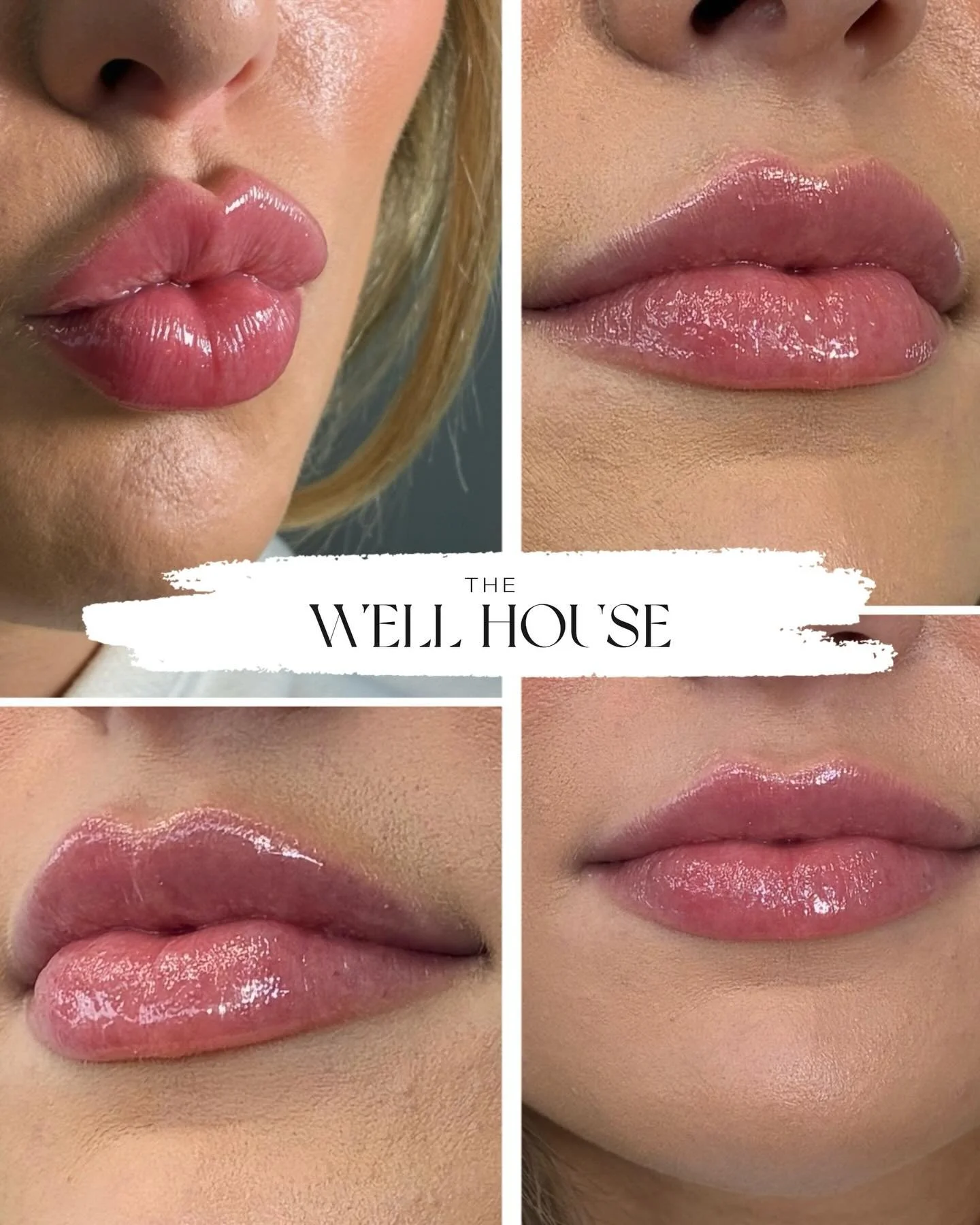 🪧 This is your sign you don&rsquo;t need a full syringe for beautiful lips. 🤍

This result was achieved with &frac12; syringe of HA filler to enhance:
✨ Symmetry
✨ Softness
✨ Vertical height

The goal is always natural, balanced results and never o