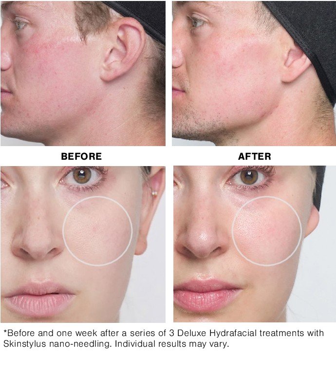 Fine line reduction facial