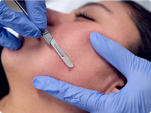 Dermaplaning facial exfoliation treatment