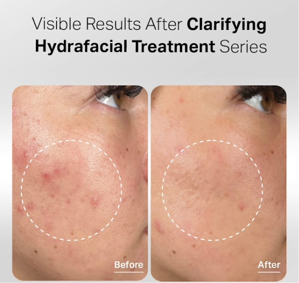 Before and after results of Hydrafacial clarifying treatment for blemish-prone skin