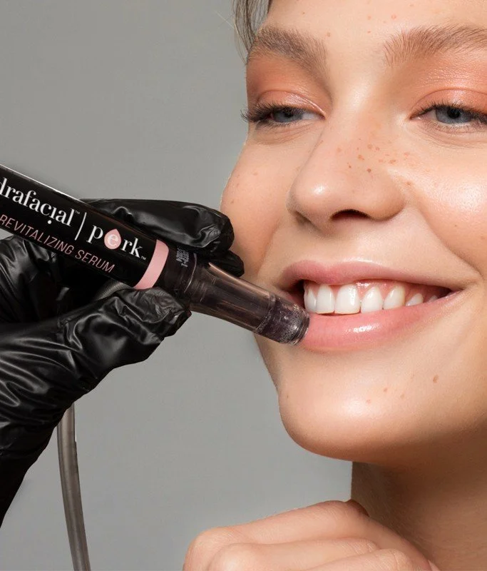 Close-up of a woman smiling as a medical professional administers a lip filler injection with a syringe labeled 'Revitalizing Serum.'