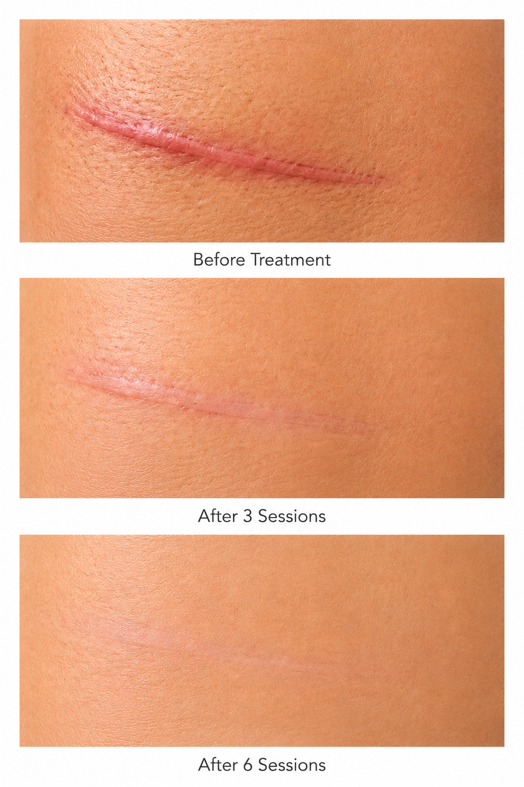 Inkless Scar Revision & Scar Restoration