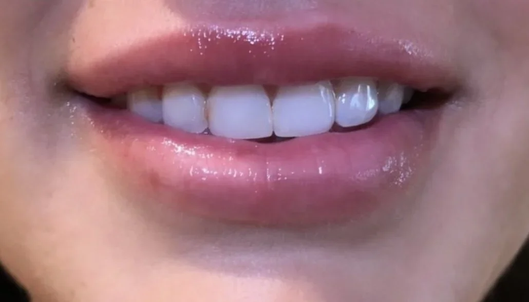 Close-up of a smiling person's lips and teeth, showing white teeth and pink lips.