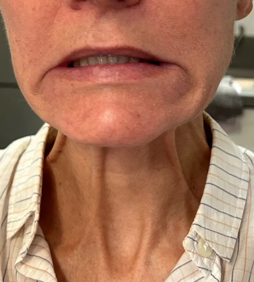 Close-up of a person's lower face and neck showing dry, cracked lips and visible neck veins.