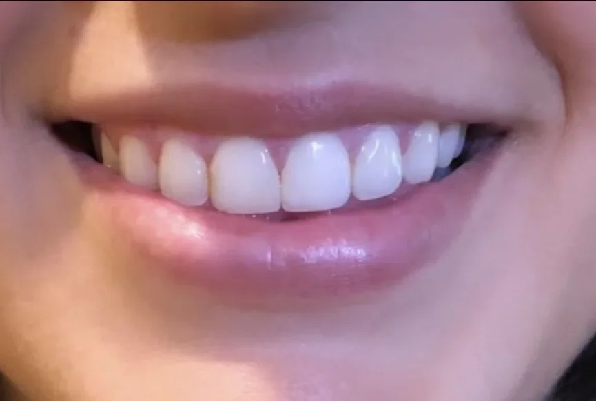 Close-up of a person's smiling mouth showing straight, white teeth.