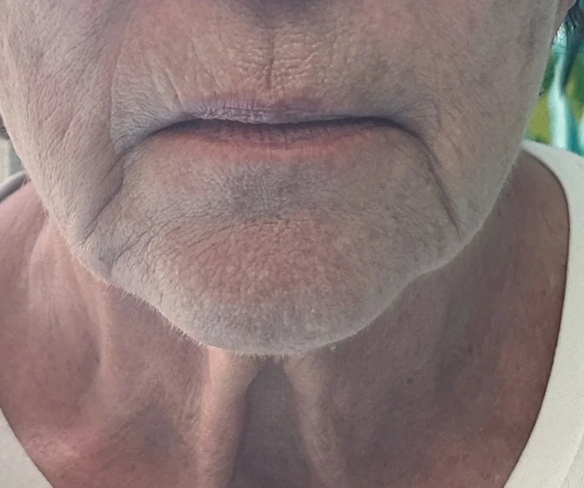 Close-up of an elderly person's mouth and chin with wrinkled skin.
