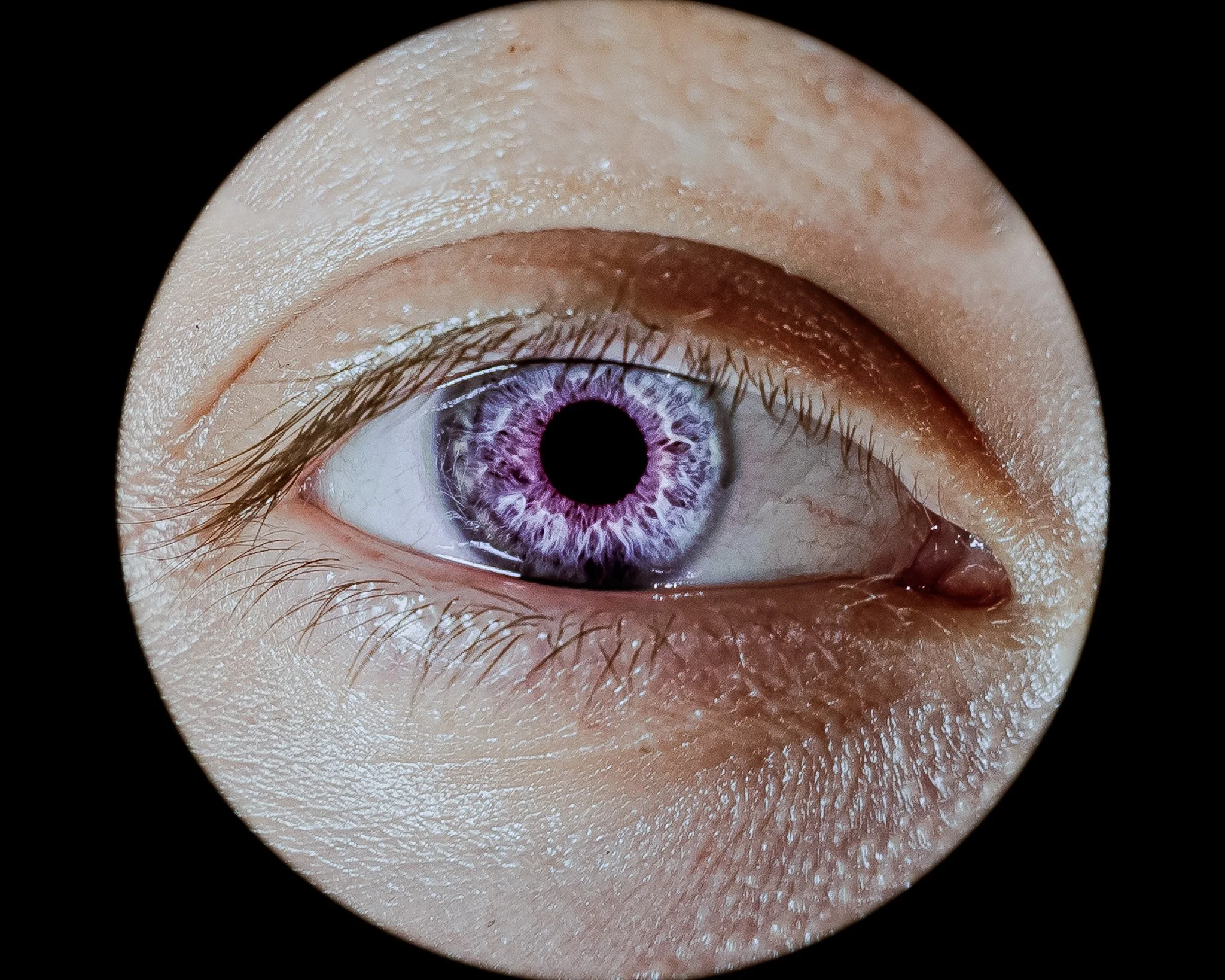 Close-up of a human eye with a purple and white iris, looking straight ahead, surrounded by skin and eyelashes.