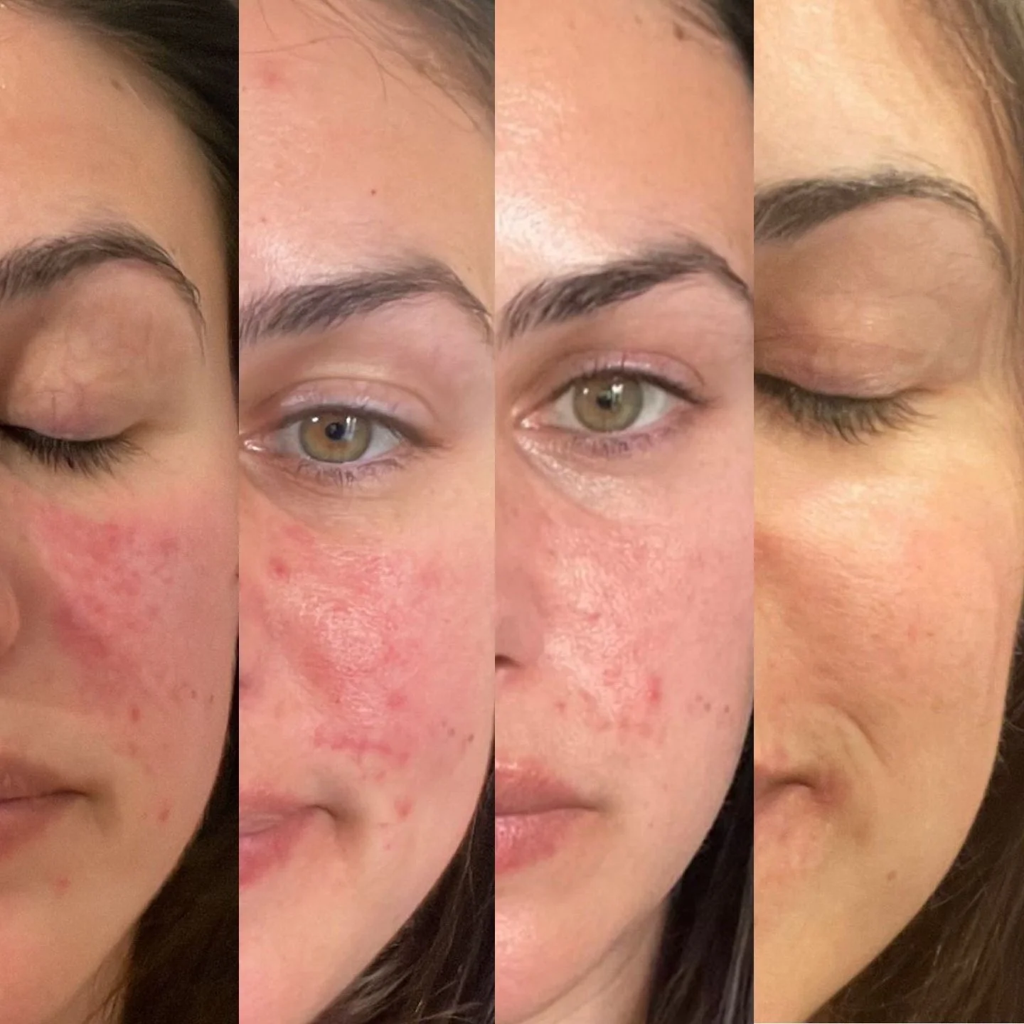 This lovely client came to me struggling with papulopustular rosacea - a type of rosacea that shows up as redness, sensitivity and acne like breakouts.
It’s often mistaken for acne but the two need a very different approach to treatments to ac