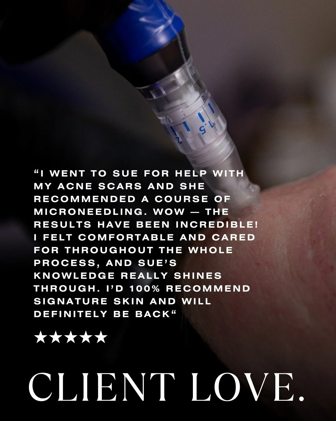Acne scars can be deeply personal. For many of my clients, they’re a reminder of a time when their skin felt out of their control, and it can take real courage to seek help after trying so many things that haven’t worked.
That’s wh