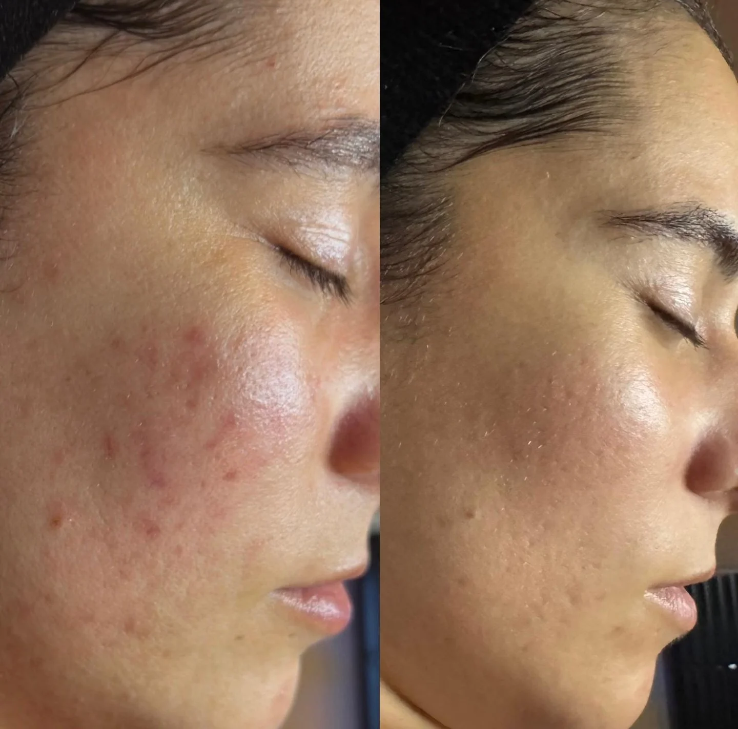 Real skin confidence looks like this 🤍
My lovely patient came to see me after struggling with acne scarring and post-inflammatory erythema (the red marks that often linger long after breakouts have gone). 
Together, we created a plan that focused