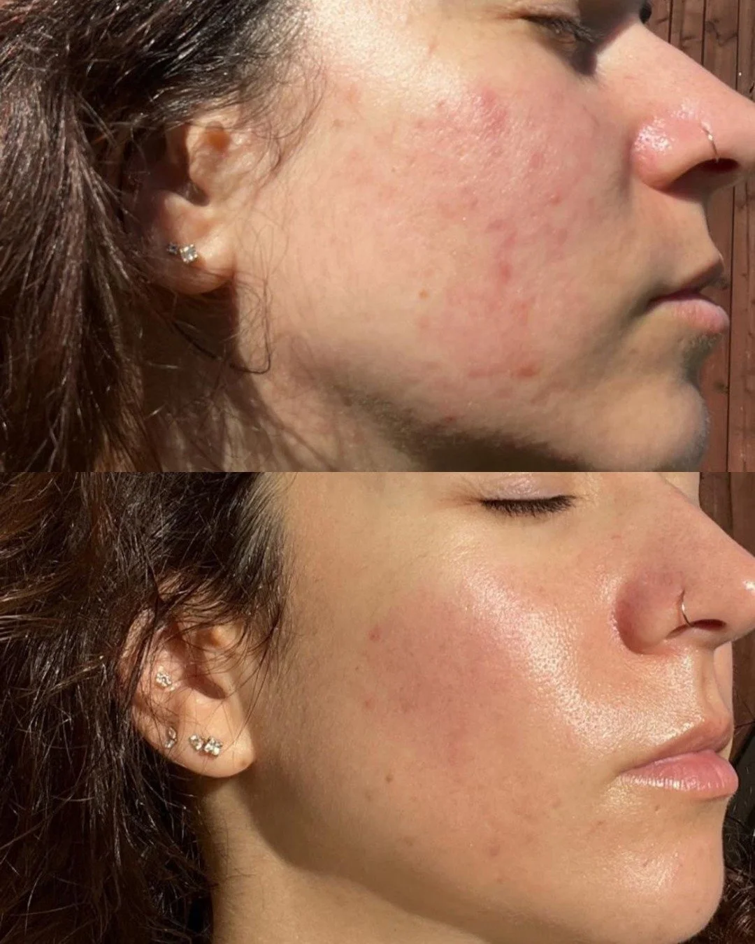 This is what consistent skin healing truly looks like 🤍✨

I&rsquo;ve shared this lovely client&rsquo;s journey before but these latest photos deserve their own moment. Her skin is now clearer, calmer, smoother, and beautifully even the kind of trans