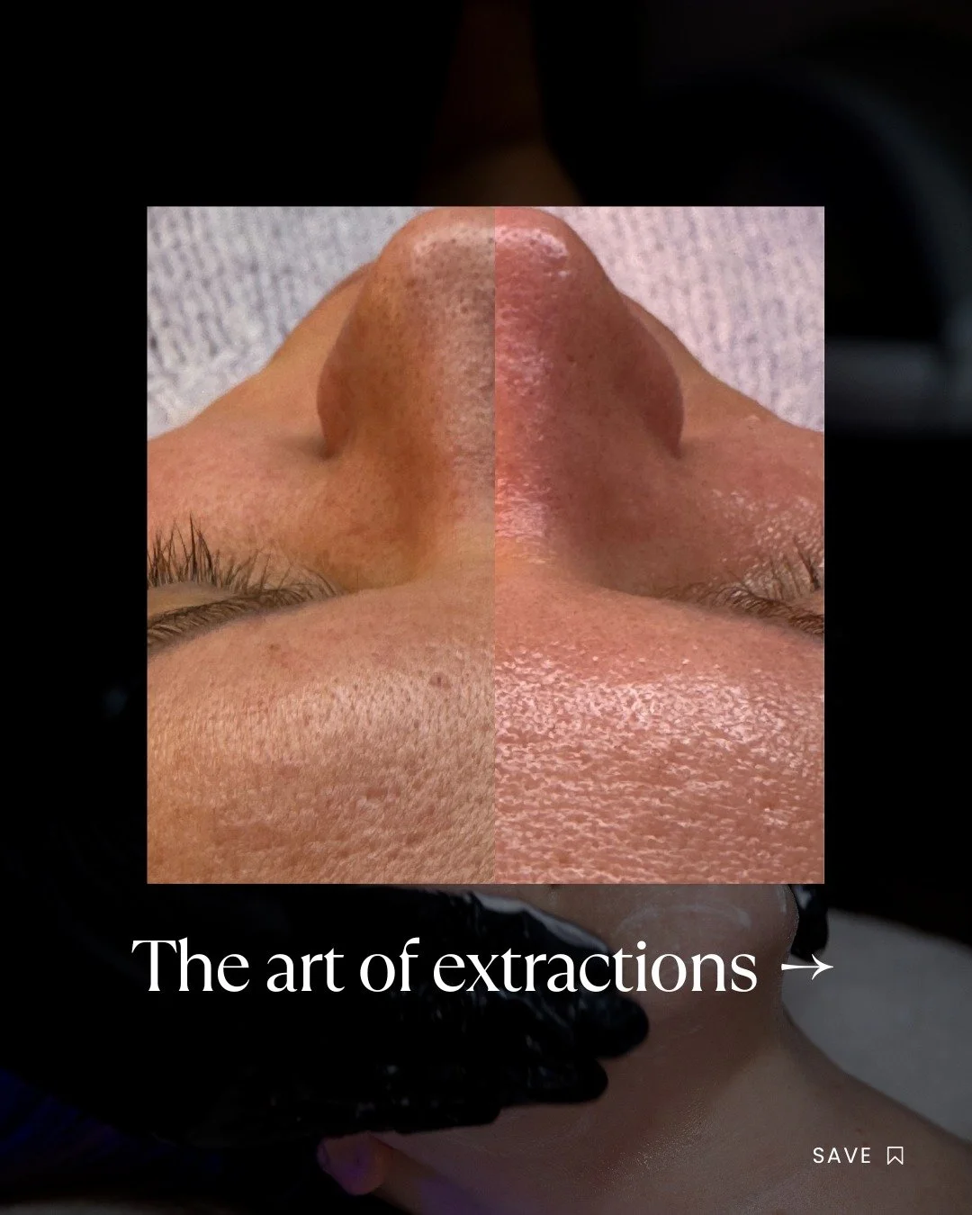 Many people think extractions are simply about squeezing out congestion, but in reality they&rsquo;re one of the most delicate, precise parts of professional skincare.

And when they&rsquo;re done at the wrong time or in the wrong way, they can leave