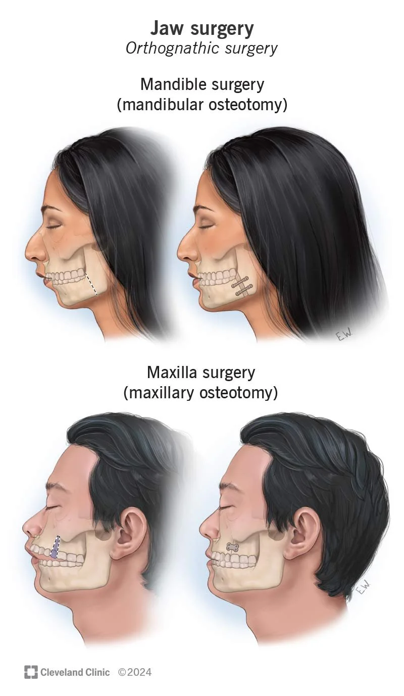 Diagram showing jaw and maxilla surgeries, including orthognathic and mandibular osteotomy for jaw surgery, and maxillary osteotomy for maxilla surgery, with side profiles of a woman and illustrations of skull bones with surgical cuts.