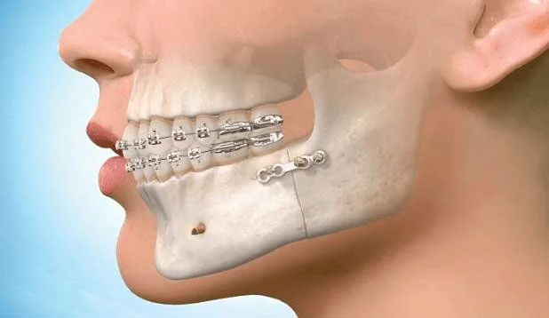 Side view of a human skull with braces on the teeth, revealing the jawbone and part of the skull.
