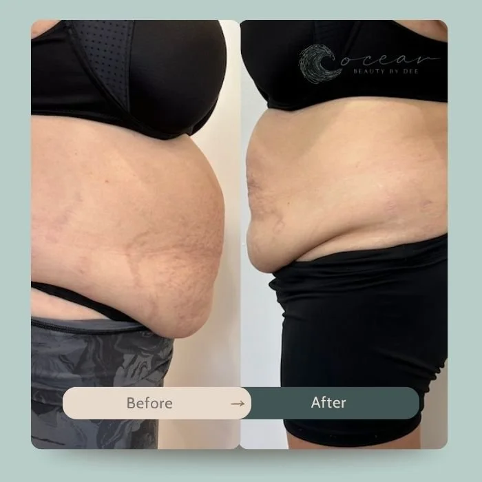 contouring-rf-skin-tightening.jpg