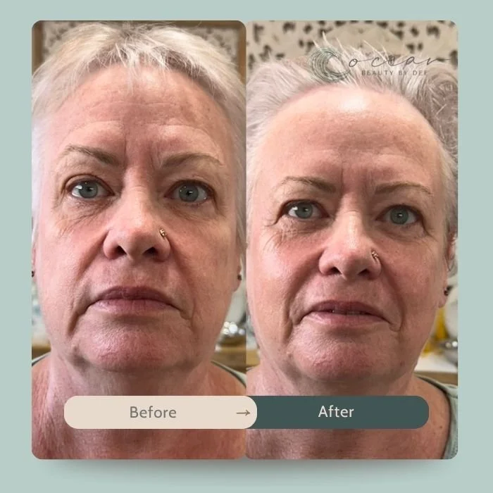 rf-skin-tightening.jpg