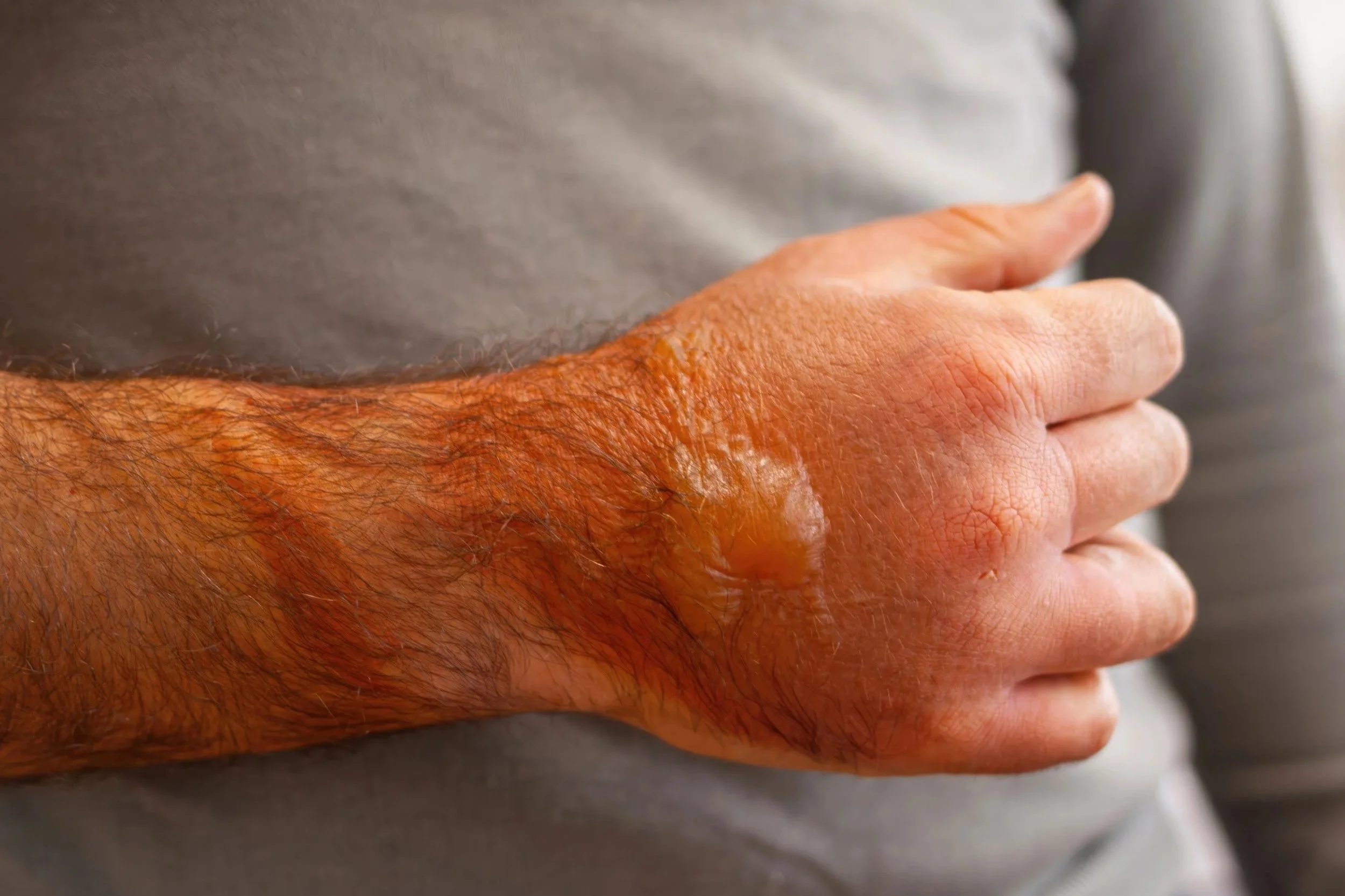 The Science of ‘Fire Cutting’: Exploring Europe’s Traditional Burn Healers