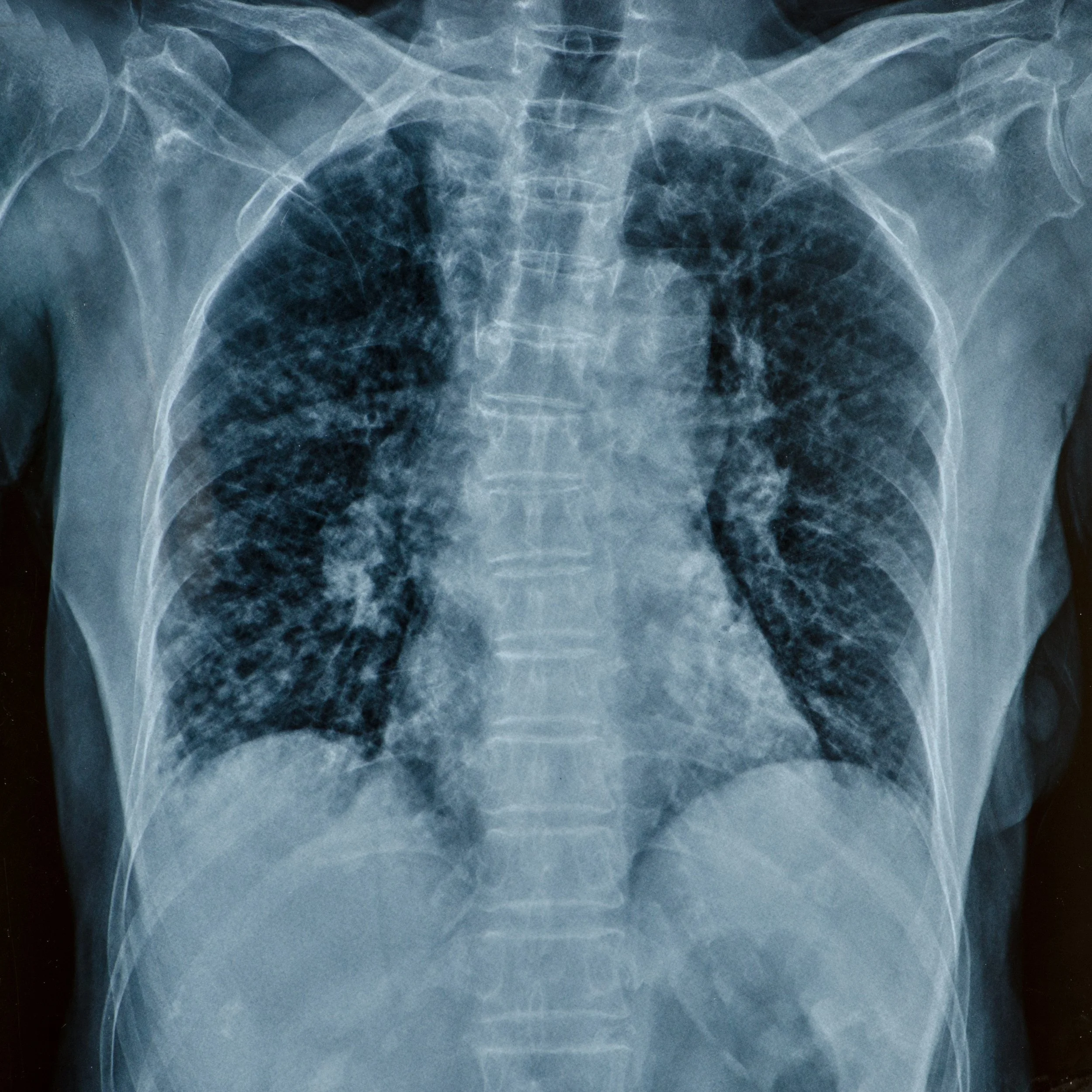 An X-ray image of a human pelvis and upper thighs showing bone structures, including the pelvis bones, hip joints, and upper femurs.