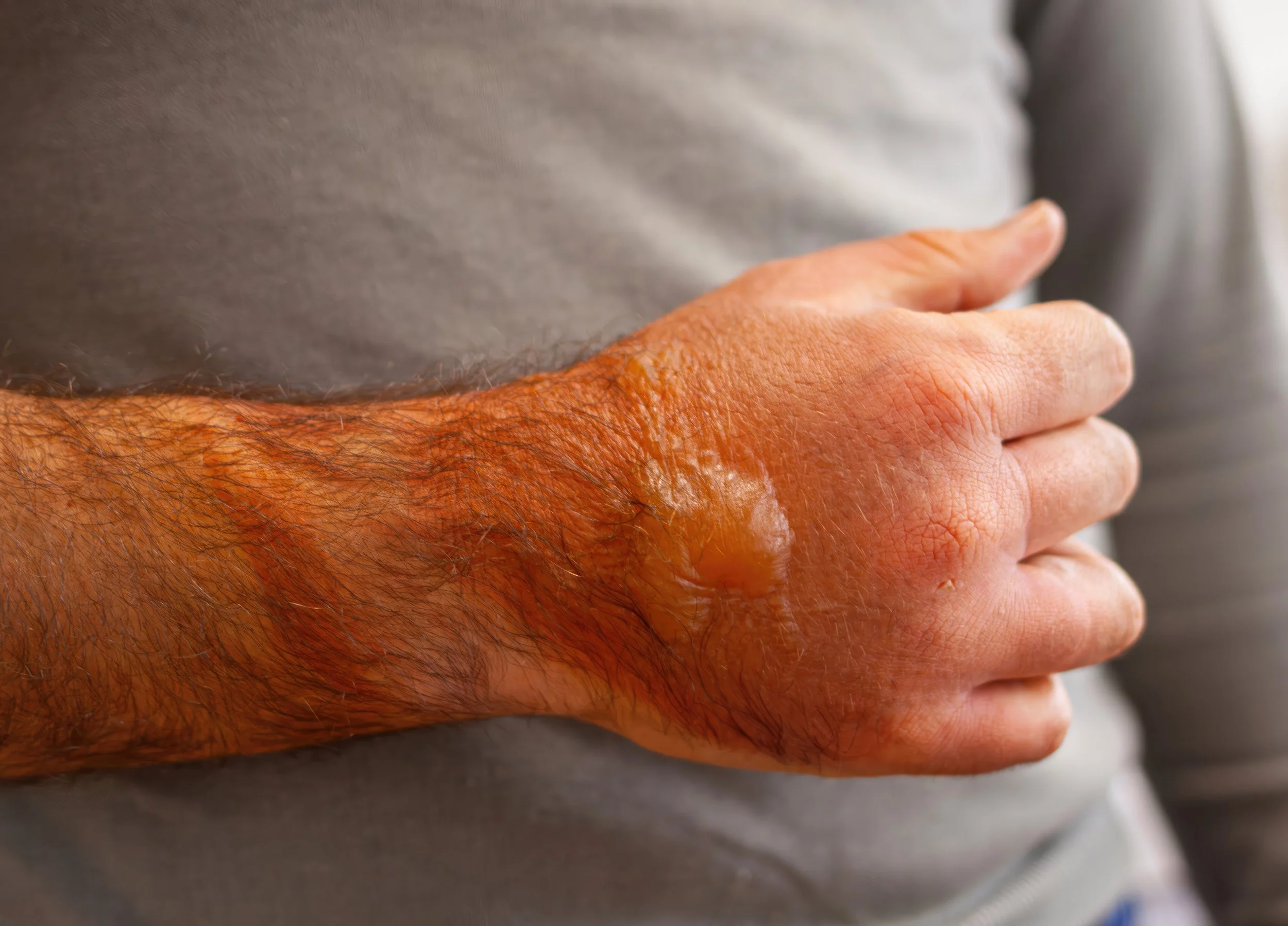 Man with a bad burn on his arm