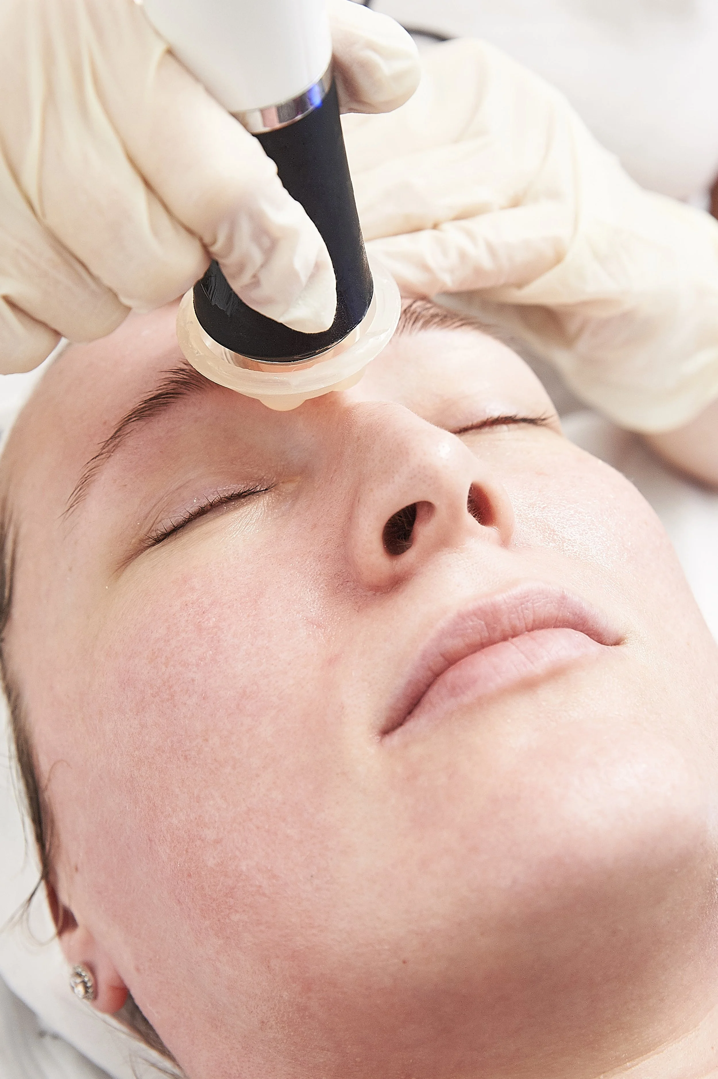 A person receiving a facial treatment with a microdermabrasion device on their cheek, lying down with eyes closed.