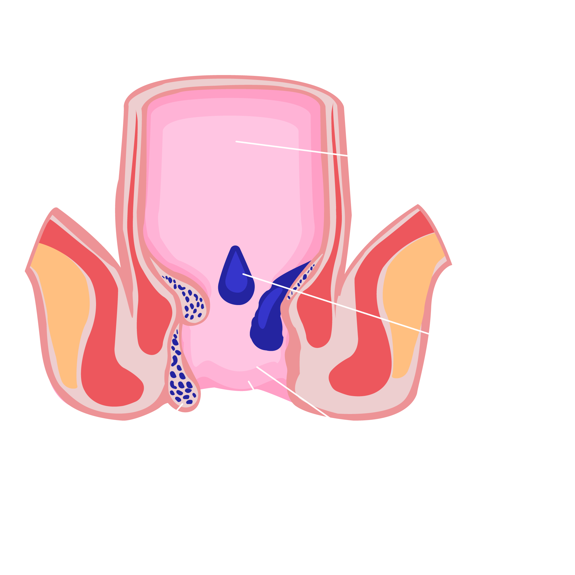 Diagram of the human rectum and anus showing internal hemorrhoid, external hemorrhoid, rectum, anus, and denate line.