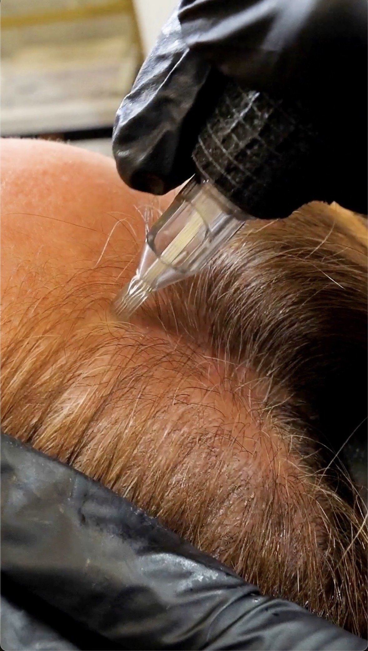 A close-up of a medical procedure where a needle is injecting an area of skin on a person's scalp, which has reddish hair.